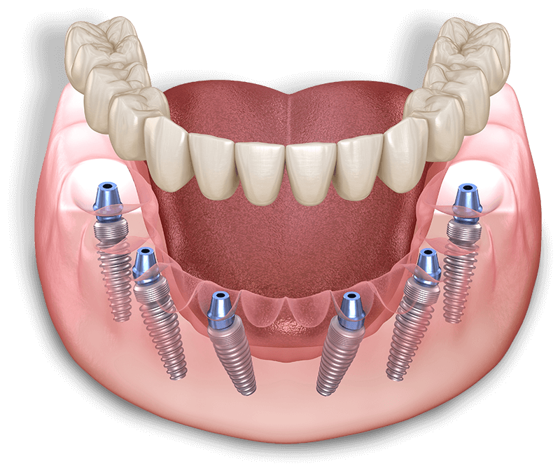 full mouth dental implant model illustration