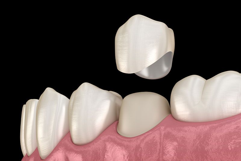 Dental crown premolar tooth assembly process. Medically accurate 3D illustration of human teeth treatment