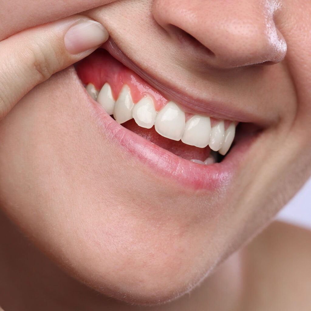 Woman showing inflamed gum